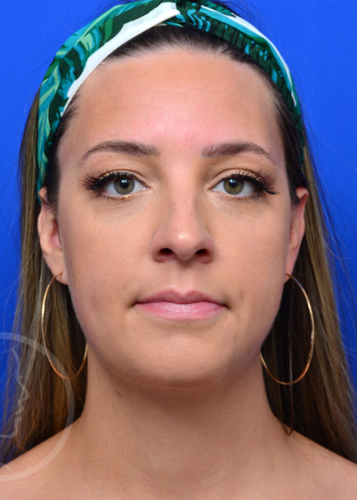 Plastic Surgery Before and After Pictures in Jacksonville, FL - Garcia Facial Plastic Surgery