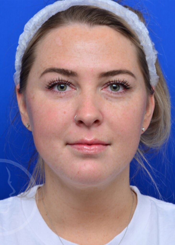 Plastic Surgery Before and After Pictures in Jacksonville, FL - Garcia Facial Plastic Surgery