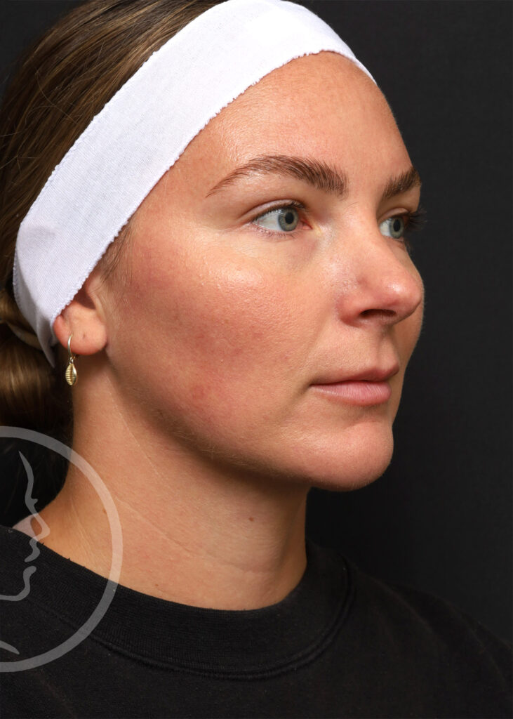 Plastic Surgery Before and After Pictures in Jacksonville, FL - Garcia Facial Plastic Surgery