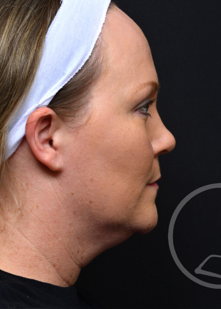 Plastic Surgery Before and After Pictures in Jacksonville, FL - Garcia Facial Plastic Surgery