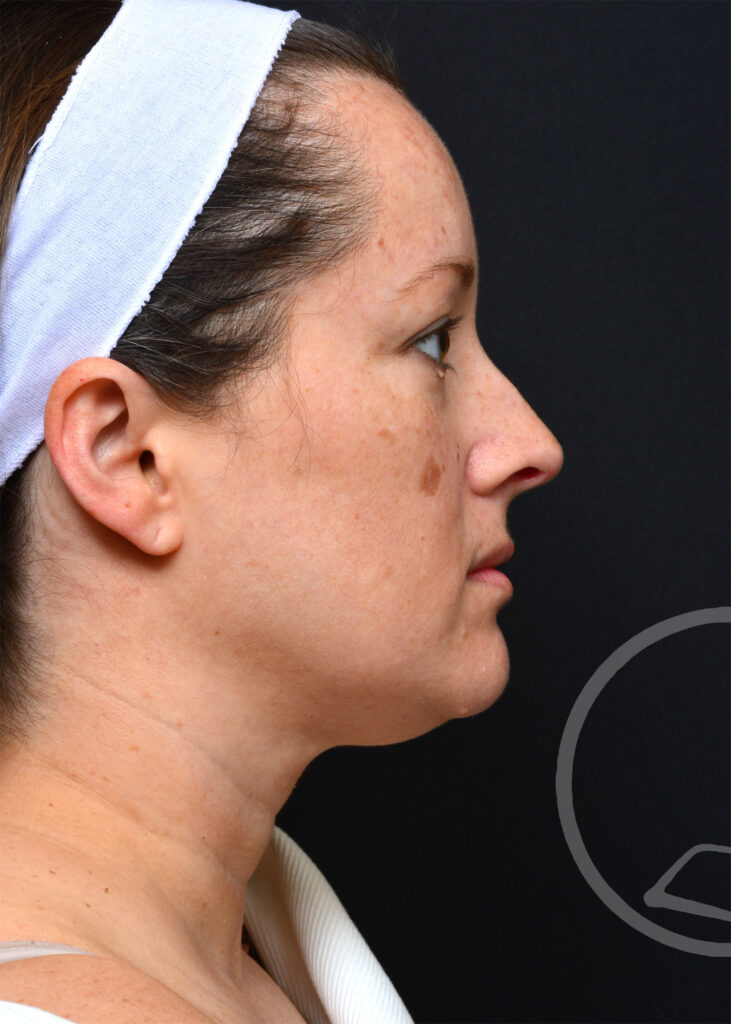 Plastic Surgery Before and After Pictures in Jacksonville, FL - Garcia Facial Plastic Surgery