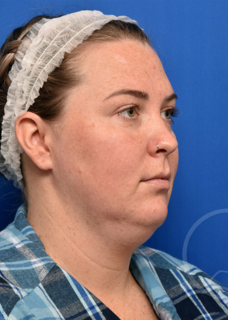 Plastic Surgery Before and After Pictures in Jacksonville, FL - Garcia Facial Plastic Surgery