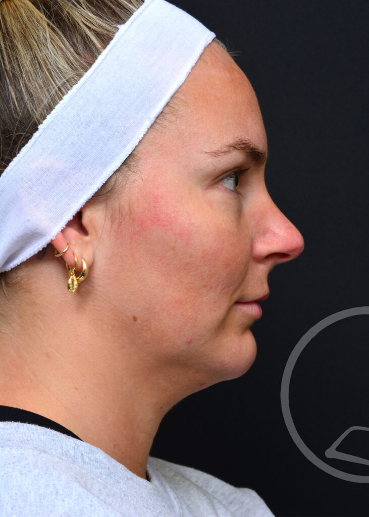 Plastic Surgery Before and After Pictures in Jacksonville, FL - Garcia Facial Plastic Surgery
