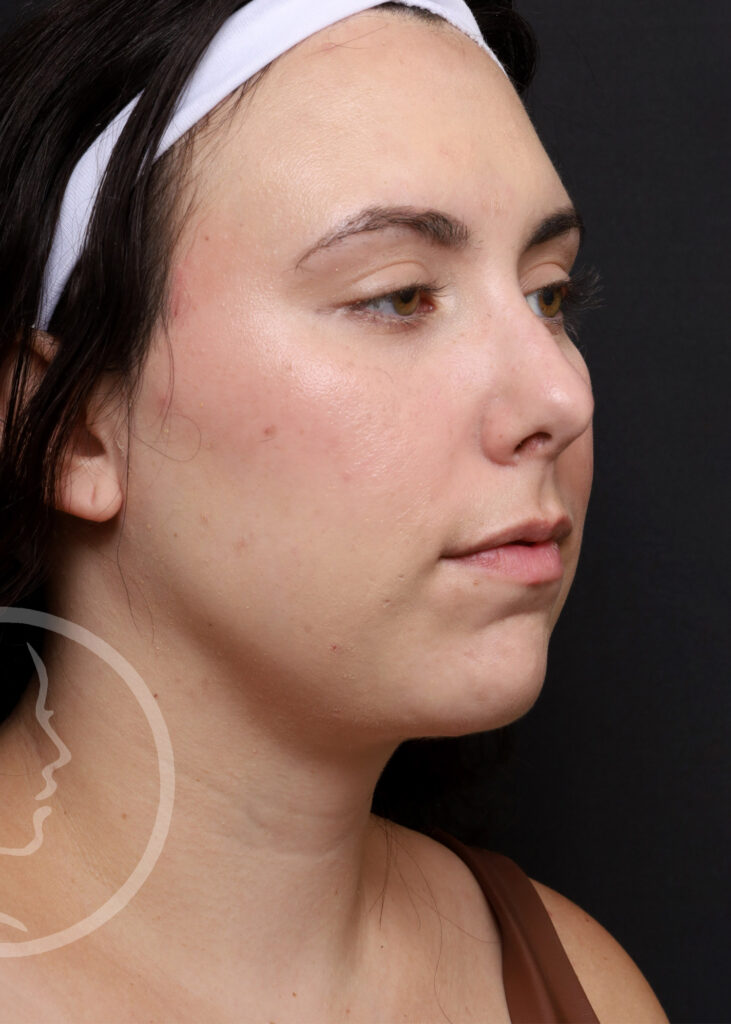 Plastic Surgery Before and After Pictures in Jacksonville, FL - Garcia Facial Plastic Surgery