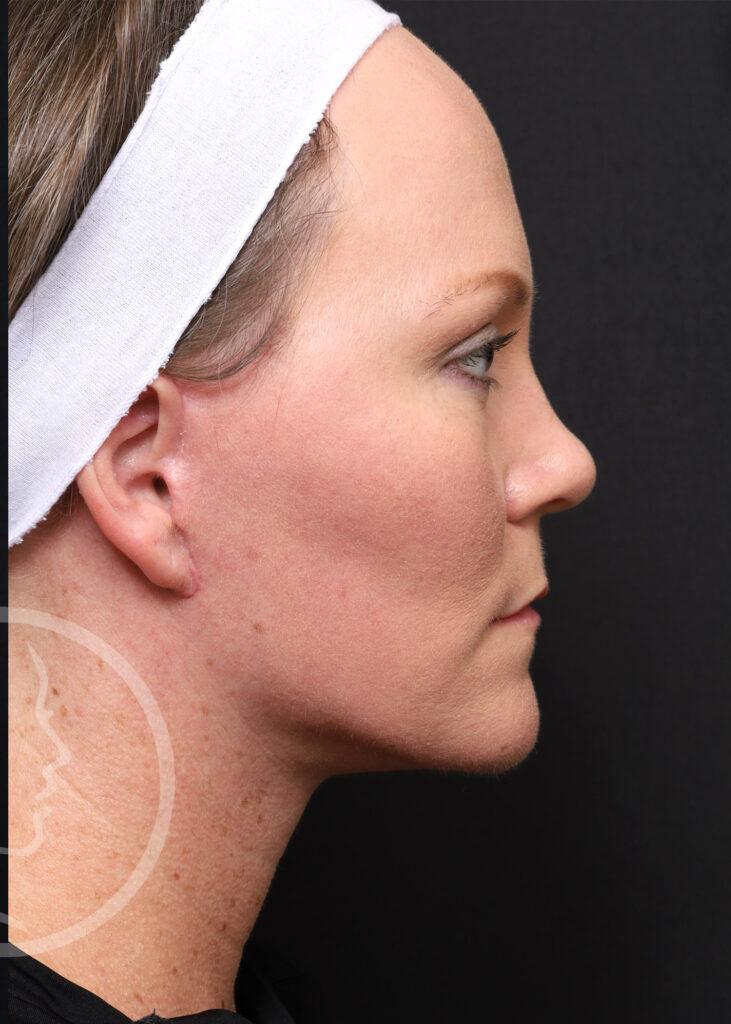 Plastic Surgery Before and After Pictures in Jacksonville, FL - Garcia Facial Plastic Surgery