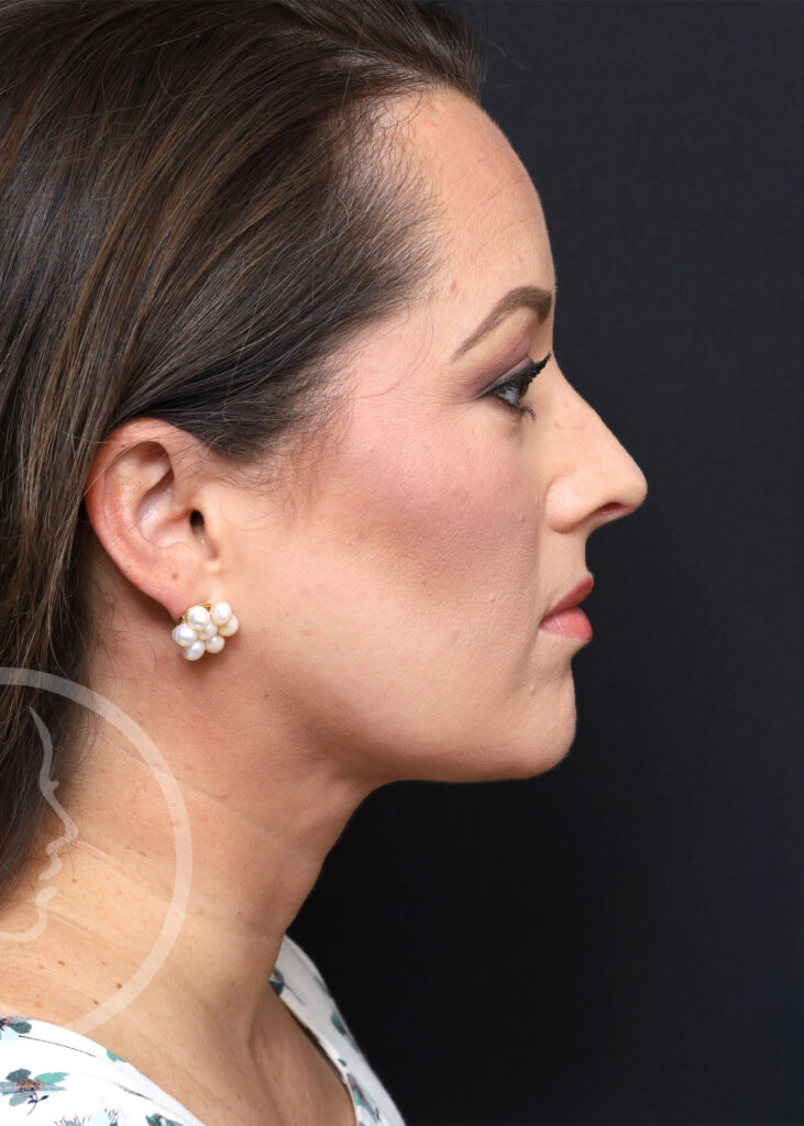Plastic Surgery Before and After Pictures in Jacksonville, FL - Garcia Facial Plastic Surgery