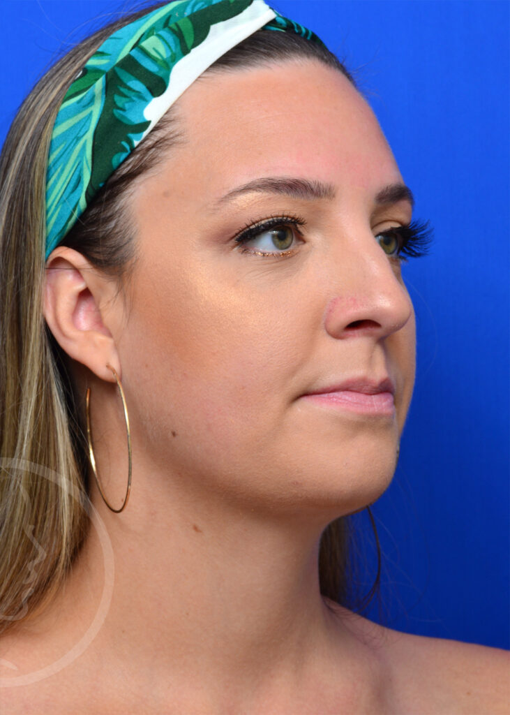 Plastic Surgery Before and After Pictures in Jacksonville, FL - Garcia Facial Plastic Surgery