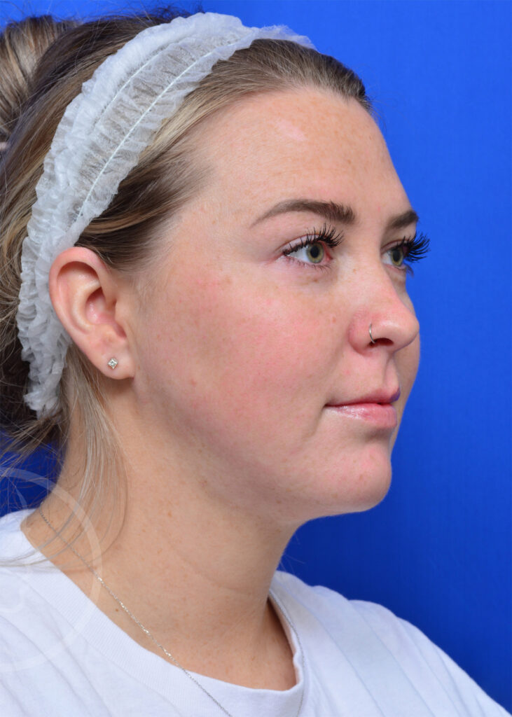 Plastic Surgery Before and After Pictures in Jacksonville, FL - Garcia Facial Plastic Surgery