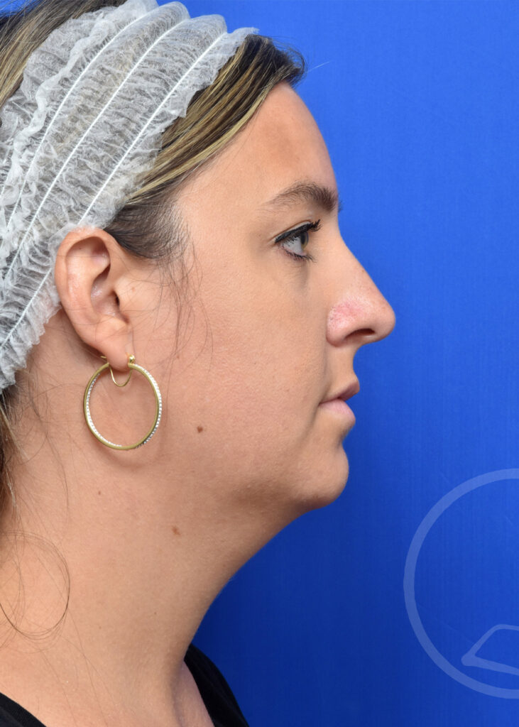 Plastic Surgery Before and After Pictures in Jacksonville, FL - Garcia Facial Plastic Surgery