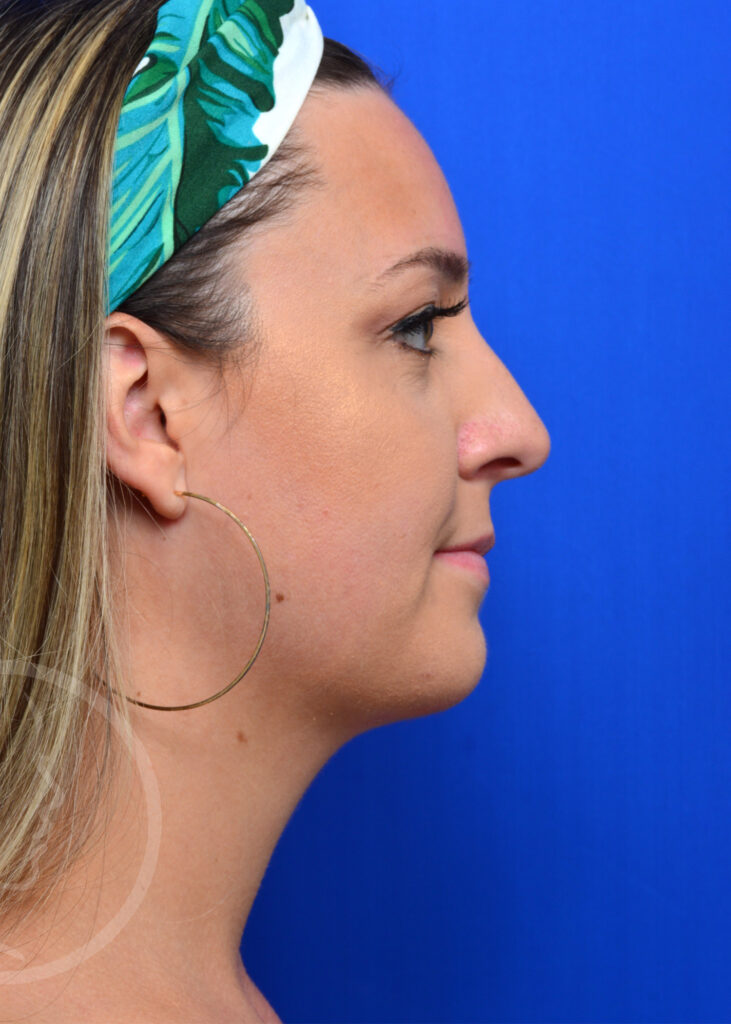 Plastic Surgery Before and After Pictures in Jacksonville, FL - Garcia Facial Plastic Surgery