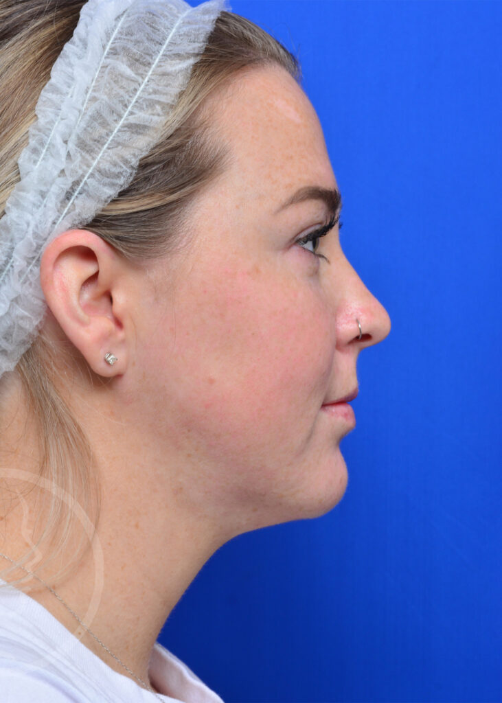 Plastic Surgery Before and After Pictures in Jacksonville, FL - Garcia Facial Plastic Surgery