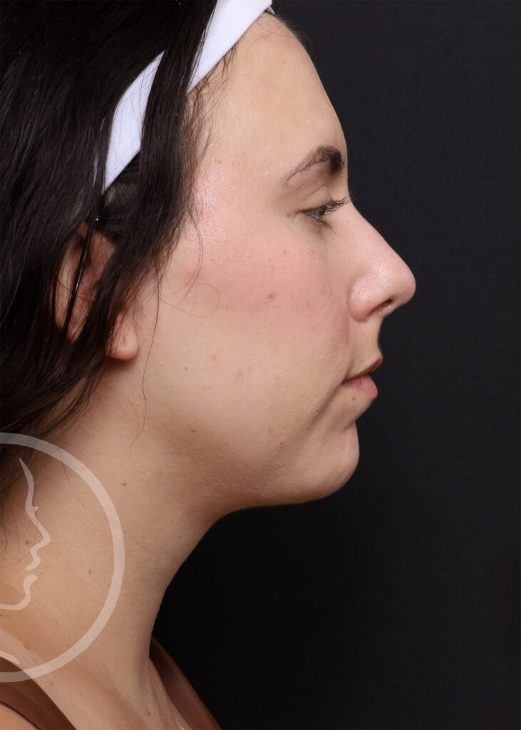 Plastic Surgery Before and After Pictures in Jacksonville, FL - Garcia Facial Plastic Surgery