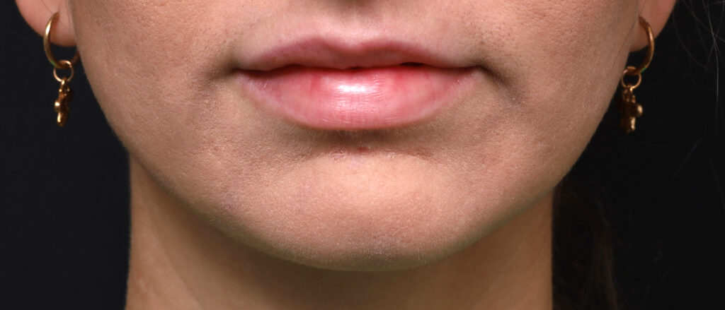 Plastic Surgery Before and After Pictures in Jacksonville, FL - Garcia Facial Plastic Surgery