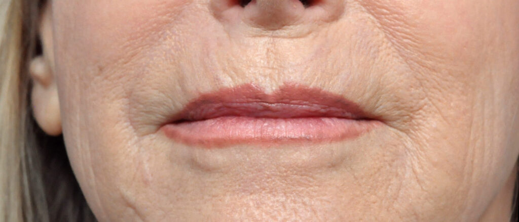 Plastic Surgery Before and After Pictures in Jacksonville, FL - Garcia Facial Plastic Surgery