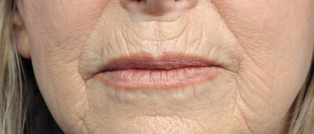 Plastic Surgery Before and After Pictures in Jacksonville, FL - Garcia Facial Plastic Surgery