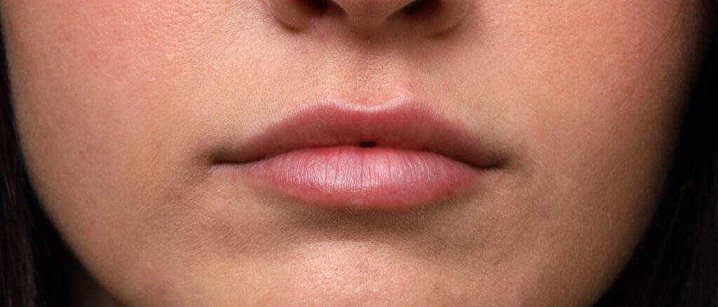 Plastic Surgery Before and After Pictures in Jacksonville, FL - Garcia Facial Plastic Surgery