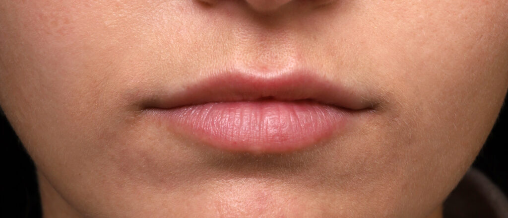 Plastic Surgery Before and After Pictures in Jacksonville, FL - Garcia Facial Plastic Surgery