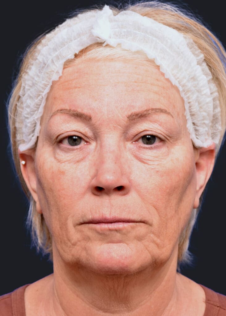 Plastic Surgery Before and After Pictures in Jacksonville, FL - Garcia Facial Plastic Surgery