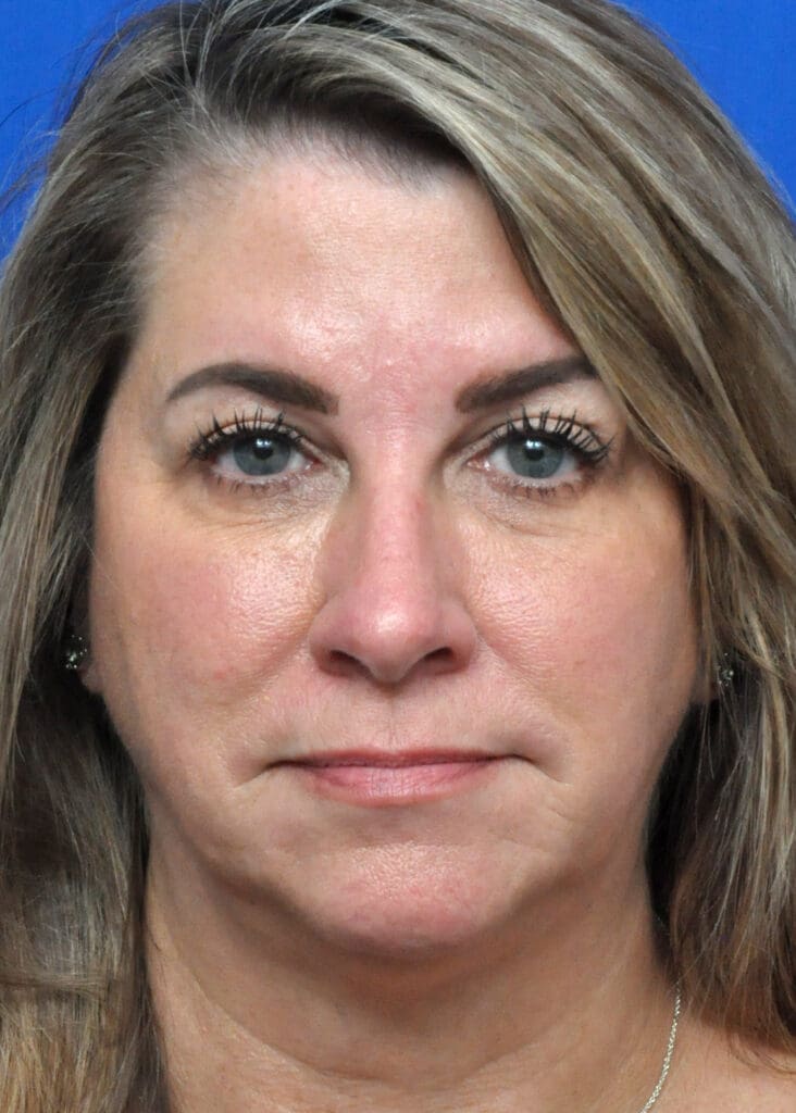 Plastic Surgery Before and After Pictures in Jacksonville, FL - Garcia Facial Plastic Surgery