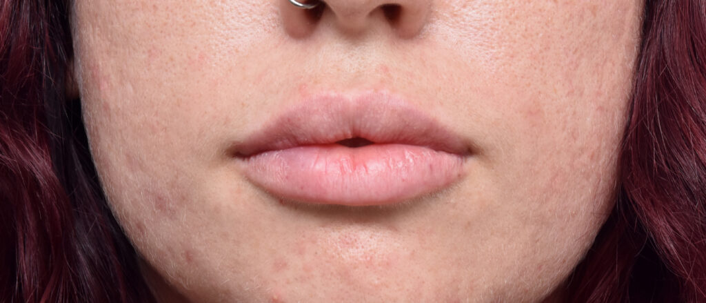 Plastic Surgery Before and After Pictures in Jacksonville, FL - Garcia Facial Plastic Surgery