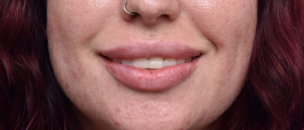 Plastic Surgery Before and After Pictures in Jacksonville, FL - Garcia Facial Plastic Surgery