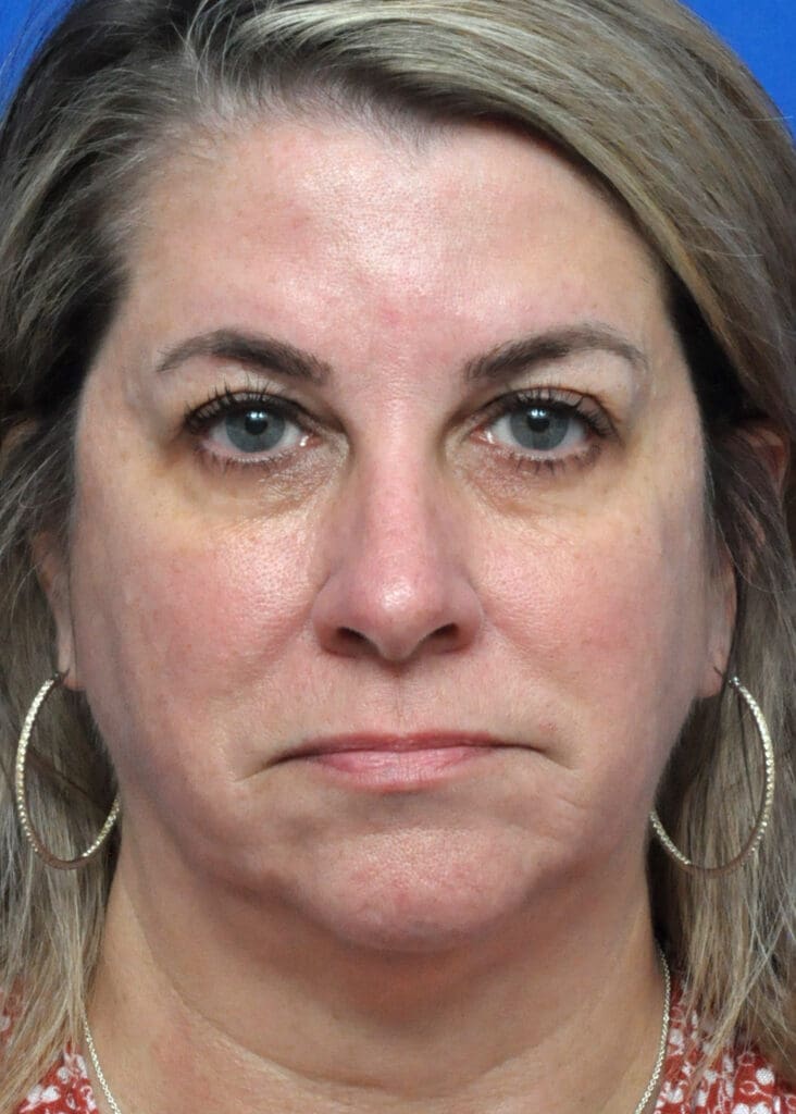 Plastic Surgery Before and After Pictures in Jacksonville, FL - Garcia Facial Plastic Surgery