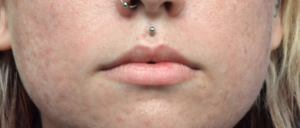 Plastic Surgery Before and After Pictures in Jacksonville, FL - Garcia Facial Plastic Surgery
