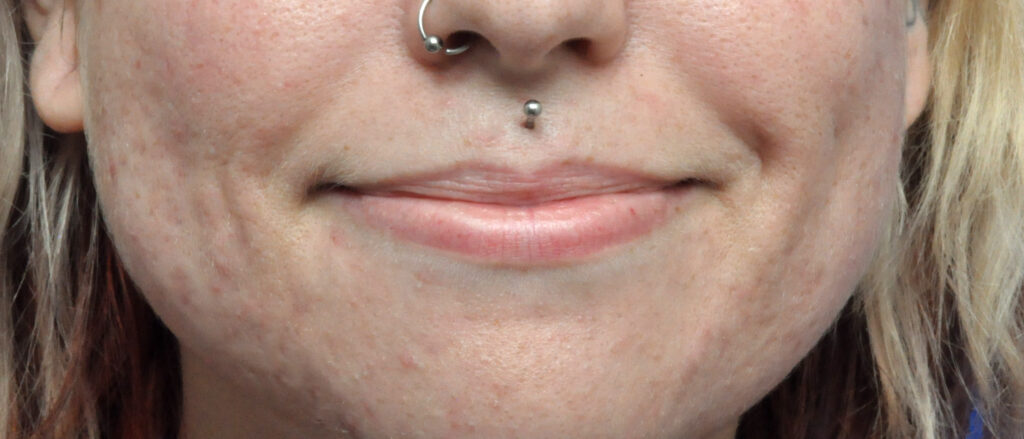 Plastic Surgery Before and After Pictures in Jacksonville, FL - Garcia Facial Plastic Surgery