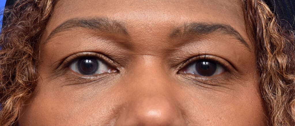 Plastic Surgery Before and After Pictures in Jacksonville, FL - Garcia Facial Plastic Surgery