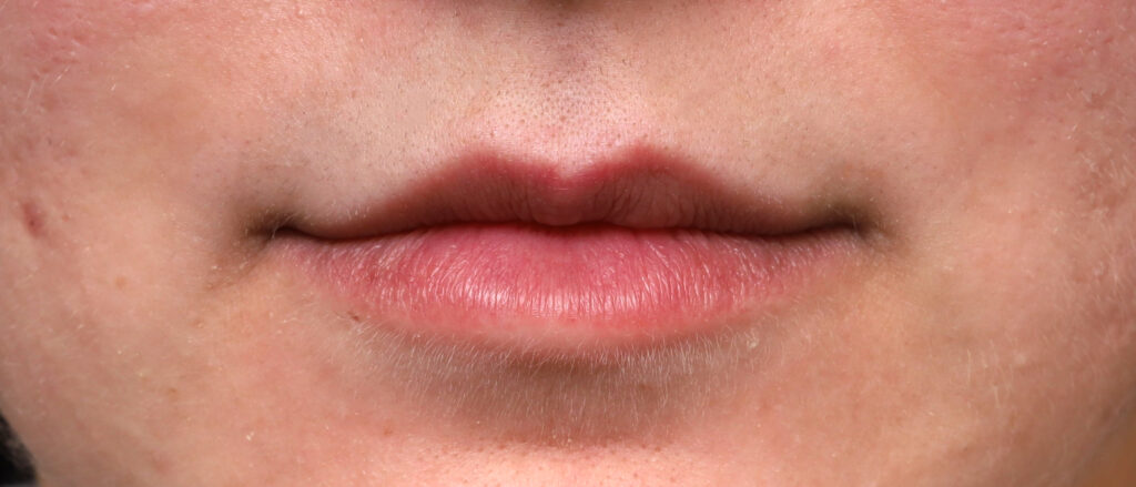 Plastic Surgery Before and After Pictures in Jacksonville, FL - Garcia Facial Plastic Surgery