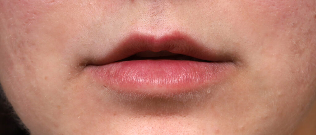 Plastic Surgery Before and After Pictures in Jacksonville, FL - Garcia Facial Plastic Surgery