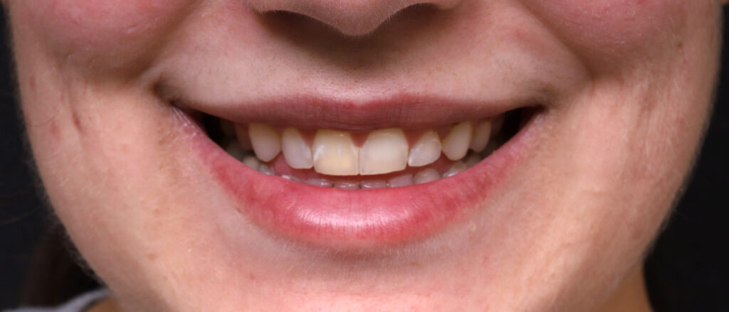 Plastic Surgery Before and After Pictures in Jacksonville, FL - Garcia Facial Plastic Surgery