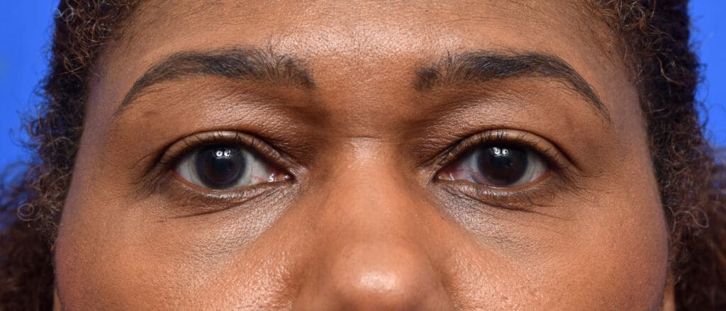 Plastic Surgery Before and After Pictures in Jacksonville, FL - Garcia Facial Plastic Surgery