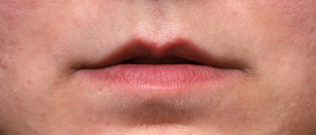 Plastic Surgery Before and After Pictures in Jacksonville, FL - Garcia Facial Plastic Surgery