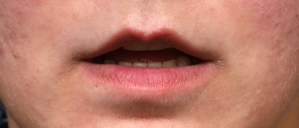 Plastic Surgery Before and After Pictures in Jacksonville, FL - Garcia Facial Plastic Surgery