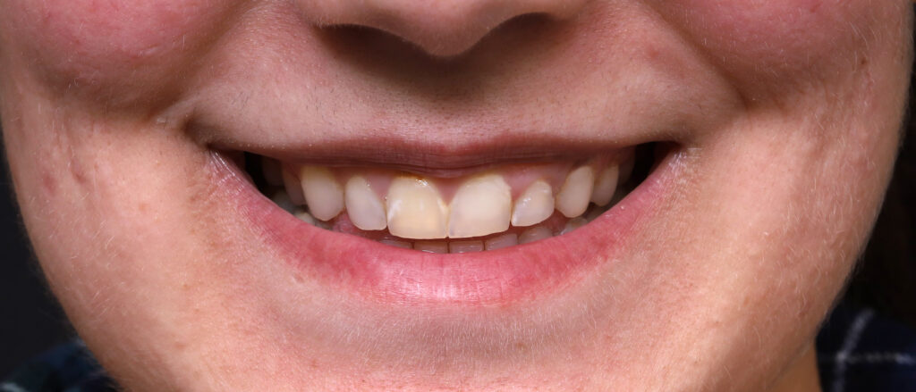 Plastic Surgery Before and After Pictures in Jacksonville, FL - Garcia Facial Plastic Surgery