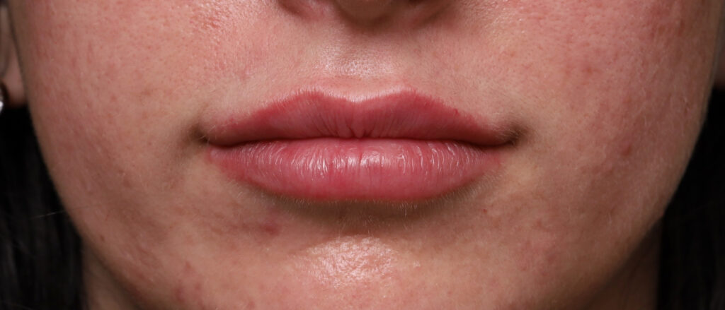 Plastic Surgery Before and After Pictures in Jacksonville, FL - Garcia Facial Plastic Surgery