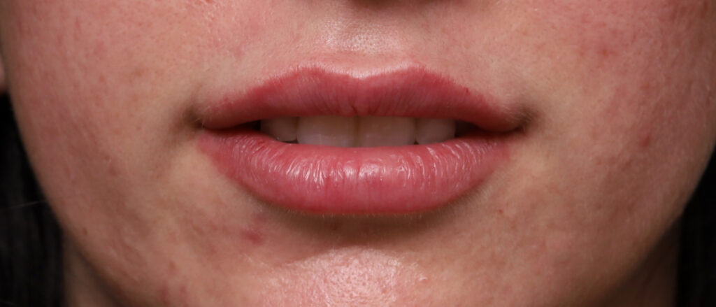 Plastic Surgery Before and After Pictures in Jacksonville, FL - Garcia Facial Plastic Surgery