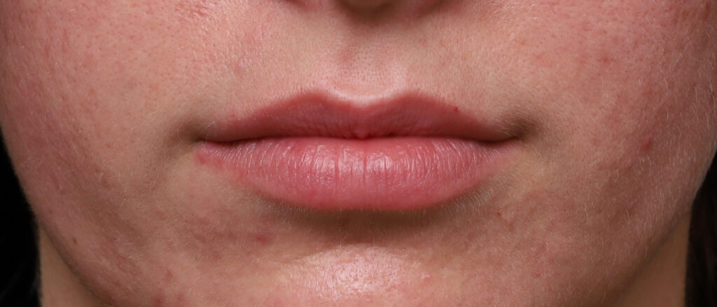 Plastic Surgery Before and After Pictures in Jacksonville, FL - Garcia Facial Plastic Surgery