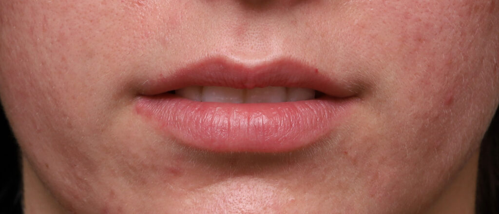 Plastic Surgery Before and After Pictures in Jacksonville, FL - Garcia Facial Plastic Surgery