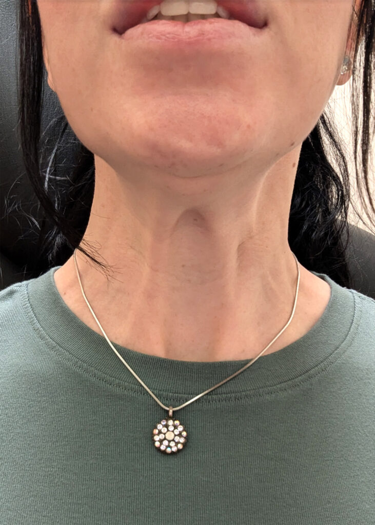 Plastic Surgery Before and After Pictures in Jacksonville, FL - Garcia Facial Plastic Surgery