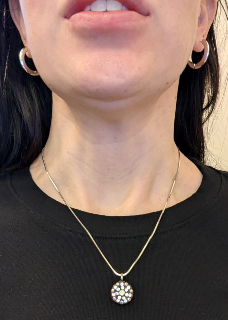 Plastic Surgery Before and After Pictures in Jacksonville, FL - Garcia Facial Plastic Surgery