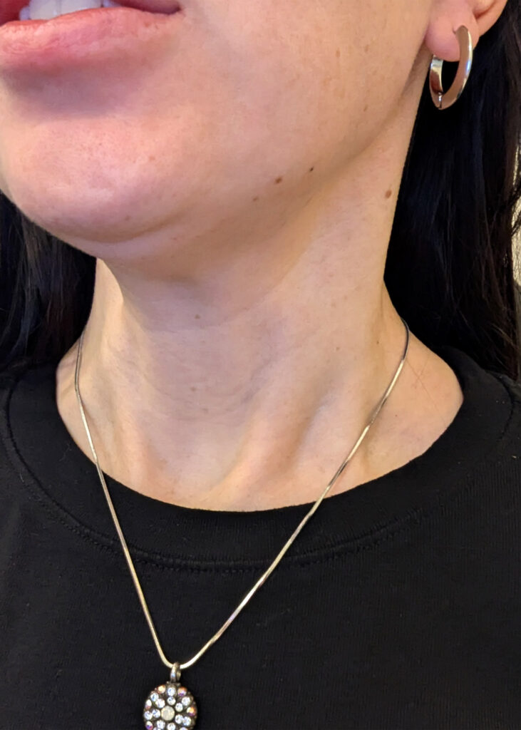 Plastic Surgery Before and After Pictures in Jacksonville, FL - Garcia Facial Plastic Surgery