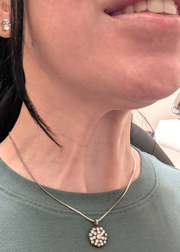 Plastic Surgery Before and After Pictures in Jacksonville, FL - Garcia Facial Plastic Surgery