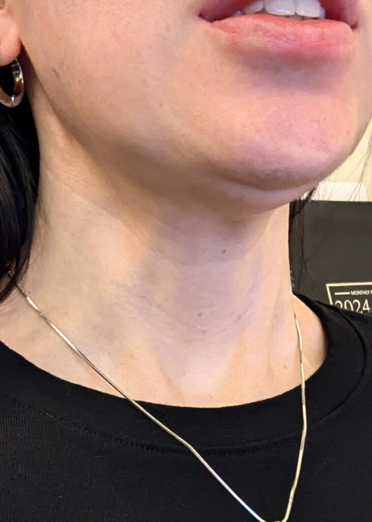Plastic Surgery Before and After Pictures in Jacksonville, FL - Garcia Facial Plastic Surgery