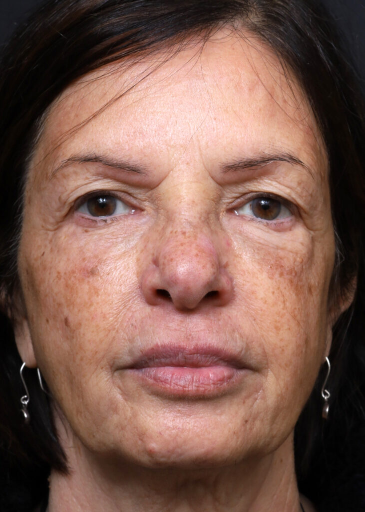 Plastic Surgery Before and After Pictures in Jacksonville, FL - Garcia Facial Plastic Surgery
