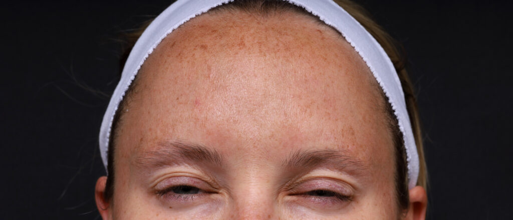 Plastic Surgery Before and After Pictures in Jacksonville, FL - Garcia Facial Plastic Surgery