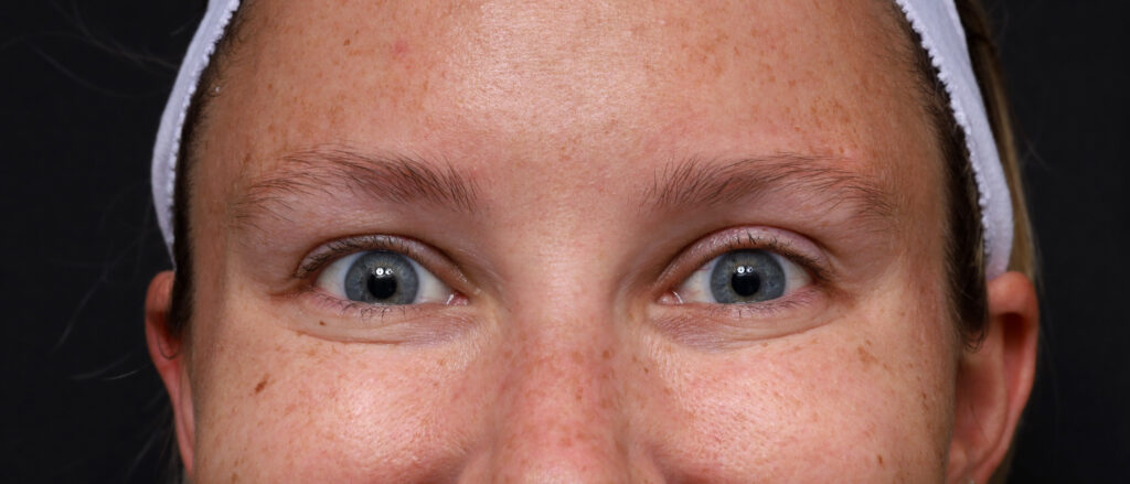 Plastic Surgery Before and After Pictures in Jacksonville, FL - Garcia Facial Plastic Surgery