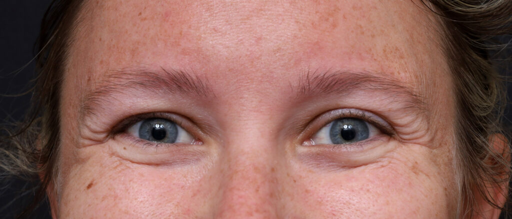 Plastic Surgery Before and After Pictures in Jacksonville, FL - Garcia Facial Plastic Surgery
