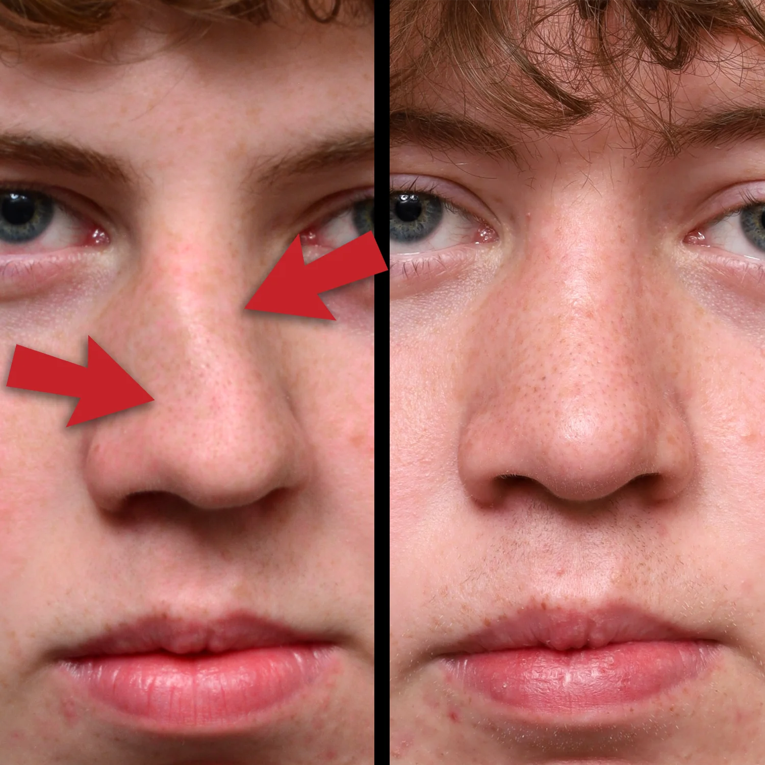 Rhinoplasty Explained playlist cover